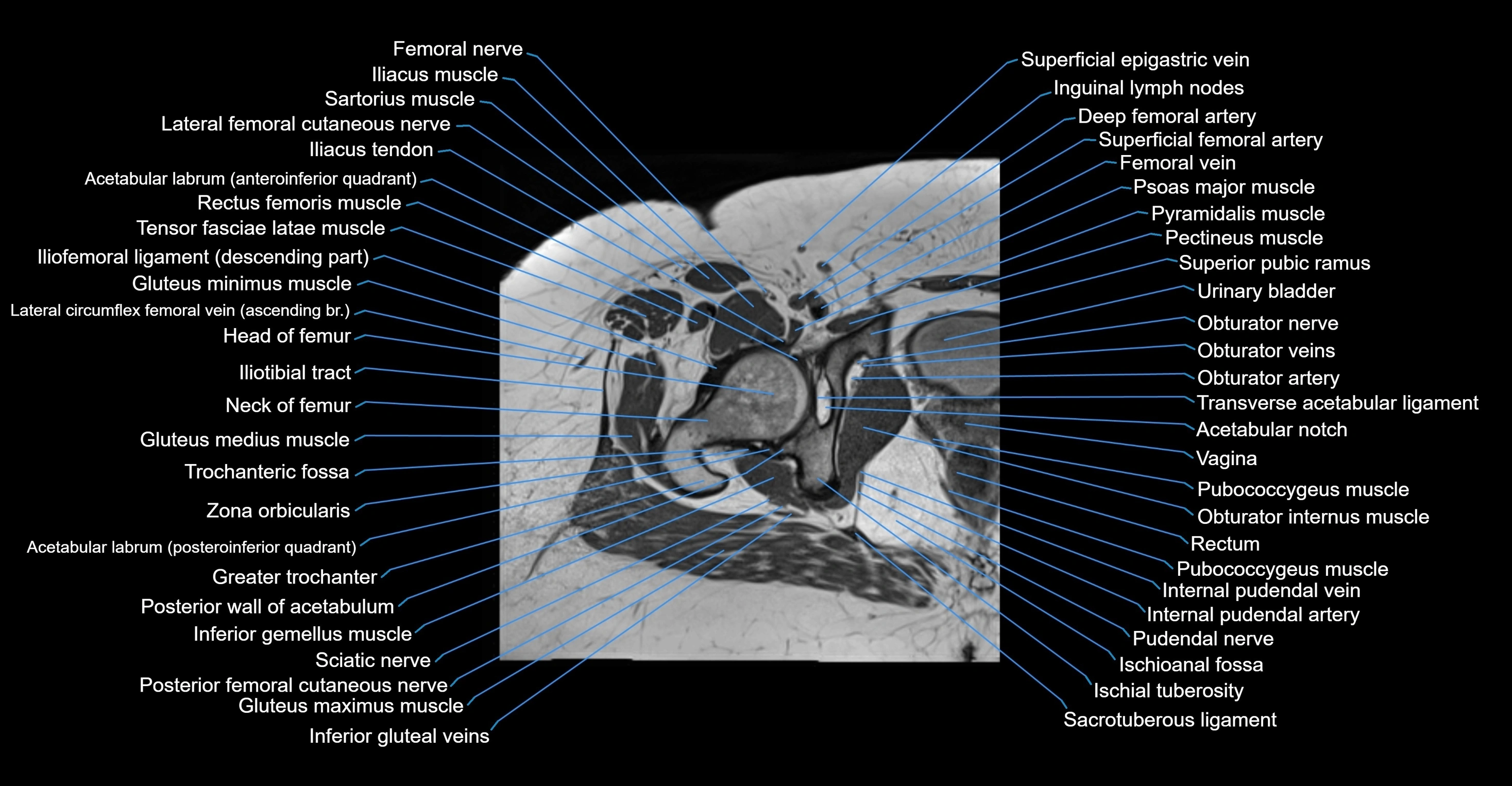MRI hip axial cross sectional anatomy 3T 3D  radiology  anatomy image-img-00001-00043.webp